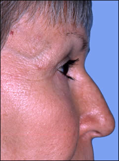Patient 251 - Side View