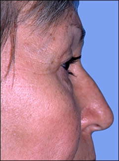 Patient 251 - Side View