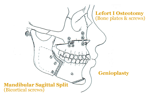 Diagram of Face After Corrective Jaw Surgery