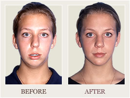 Corrective Jaw Surgery (Orthognathic)