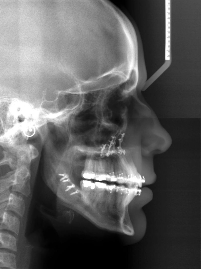 Corrective and Orthognathic Jaw Surgery Dr. Richard W. Joseph